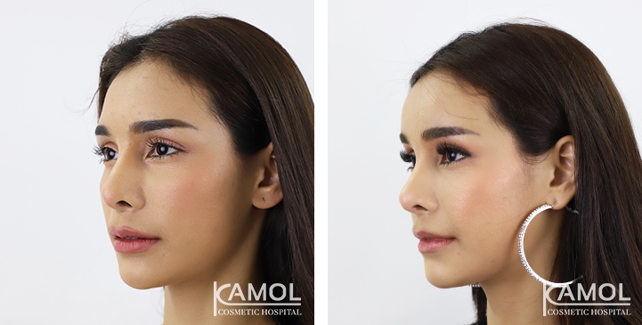 การเสริมหน้าผาก / การใส่รากเทียมหน้าผาก 4 lg 64949594d7c0f image
