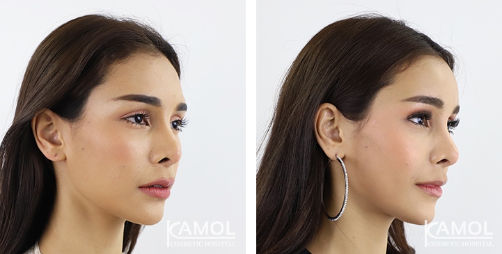 การเสริมหน้าผาก / การใส่รากเทียมหน้าผาก 5 lg 64949594d99e0 image