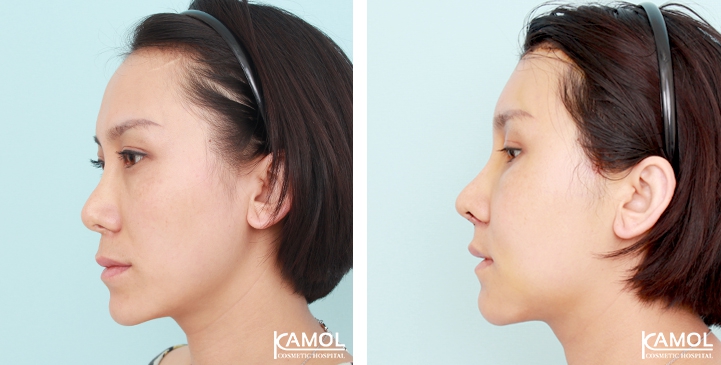 Descenso de la Línea del Cabello / Avance del Cuero Cabelludo 13 lg 649495952392d image