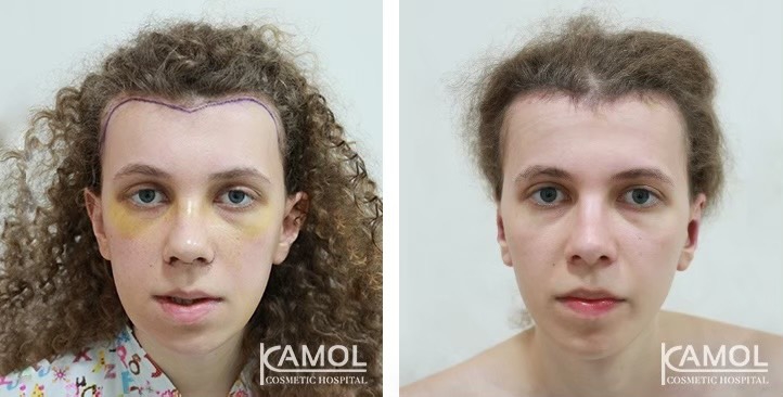 Descenso de la Línea del Cabello / Avance del Cuero Cabelludo 24 lg 6494959534f5e image