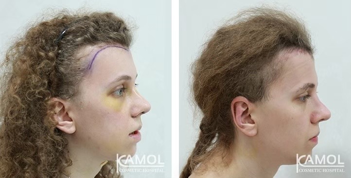 Descenso de la Línea del Cabello / Avance del Cuero Cabelludo 26 lg 6494959536b97 image