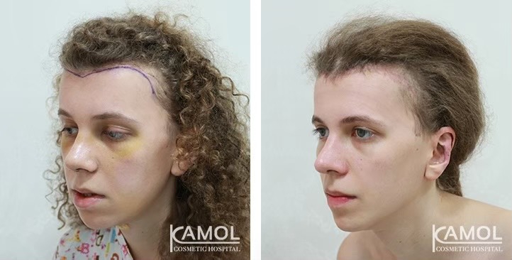Descenso de la Línea del Cabello / Avance del Cuero Cabelludo 25 lg 6494959538ccf image