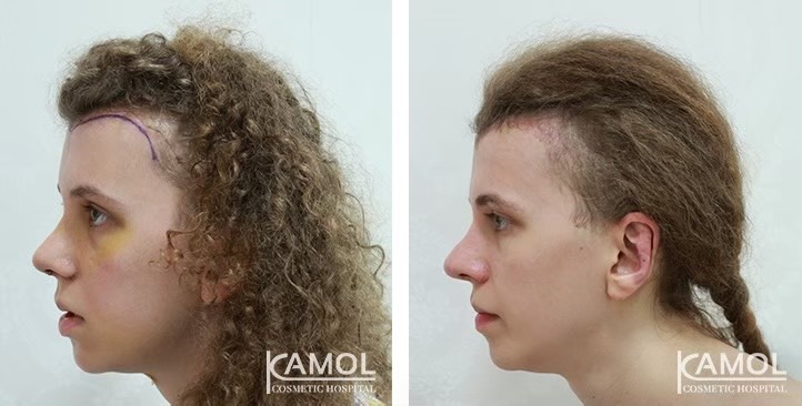 Descenso de la Línea del Cabello / Avance del Cuero Cabelludo 28 lg 649495953aa4d image