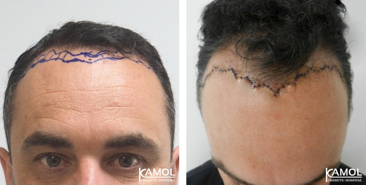 Descenso de la Línea del Cabello / Avance del Cuero Cabelludo 30 lg 649495953f3f7 image