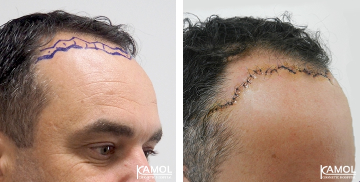 Descenso de la Línea del Cabello / Avance del Cuero Cabelludo 31 lg 6494959541642 image