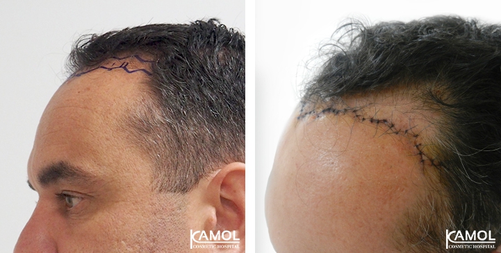 Descenso de la Línea del Cabello / Avance del Cuero Cabelludo 34 lg 64949595438d9 image