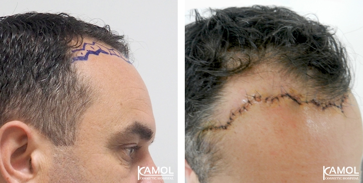 Descenso de la Línea del Cabello / Avance del Cuero Cabelludo 32 lg 649495954591e image
