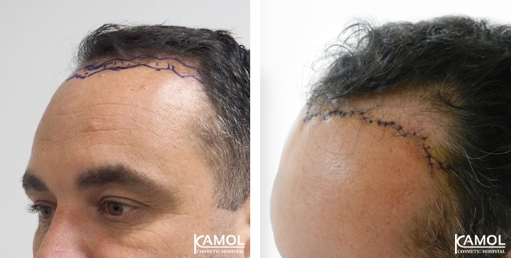 Descenso de la Línea del Cabello / Avance del Cuero Cabelludo 33 lg 64949595477ec image