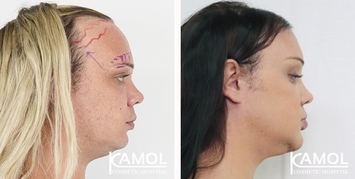 Descenso de la Línea del Cabello / Avance del Cuero Cabelludo 49 lg 649495956161e image