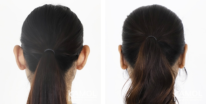 Otoplasty 5 lg 64949596a9164 image