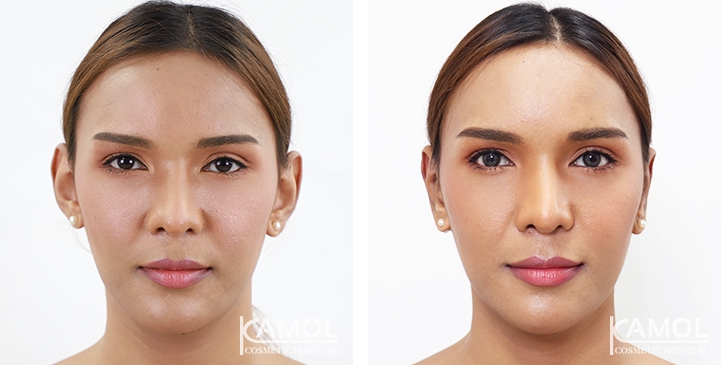 Otoplasty 7 lg 64949596abcb0 image
