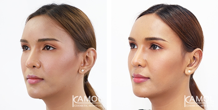 Otoplasty 10 lg 64949596adf11 image