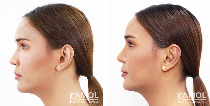Otoplasty 11 lg 64949596b01f3 image