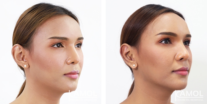 Otoplasty 8 lg 64949596b2191 image