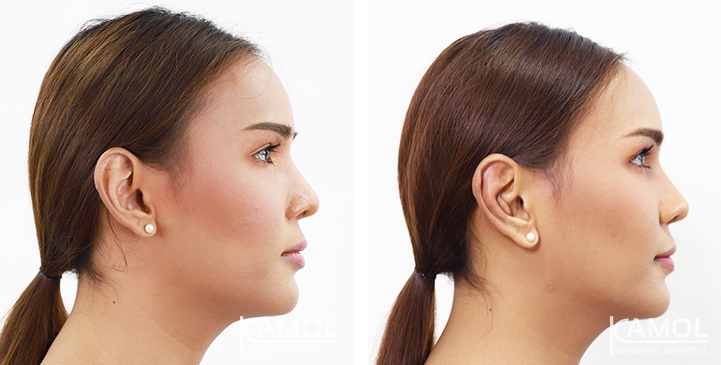 Otoplasty 9 lg 64949596b4122 image
