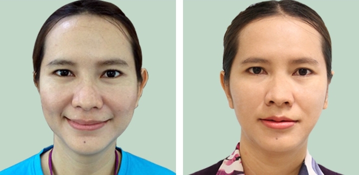 Otoplasty 14 lg 64949596b8d16 image