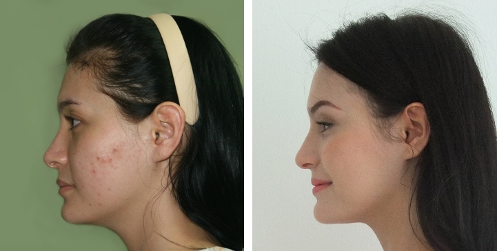 Augmentation des Pommettes / Implant de Joues 10 lg 64949596c93d2 image