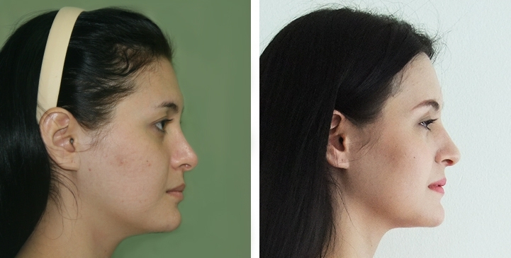 Augmentation des Pommettes / Implant de Joues 9 lg 64949596caa39 image