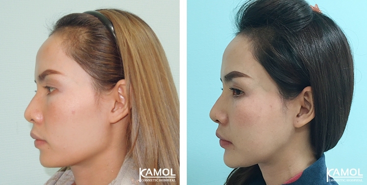 Augmentation des Pommettes / Implant de Joues 21 lg 64949596cfe85 image
