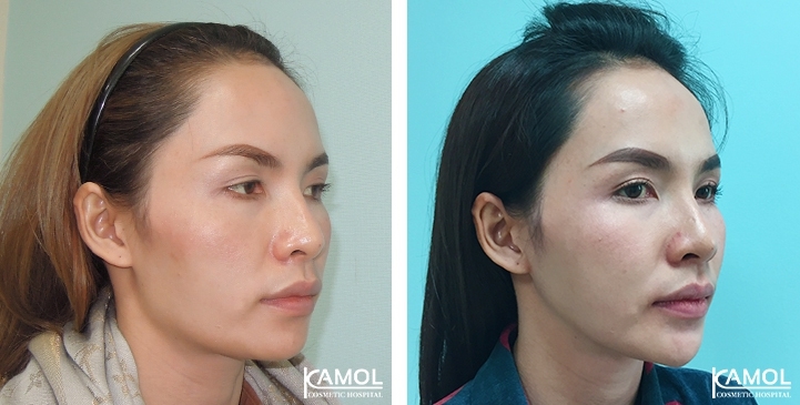 Augmentation des Pommettes / Implant de Joues 19 lg 64949596d173a image