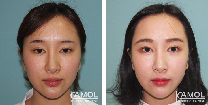 Augmentation des Pommettes / Implant de Joues 12 lg 64949596d5b03 image