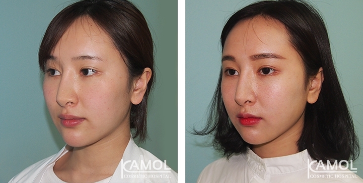 Augmentation des Pommettes / Implant de Joues 16 lg 64949596d7a25 image