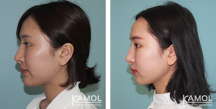 Augmentation des Pommettes / Implant de Joues 15 lg 64949596d97fa image