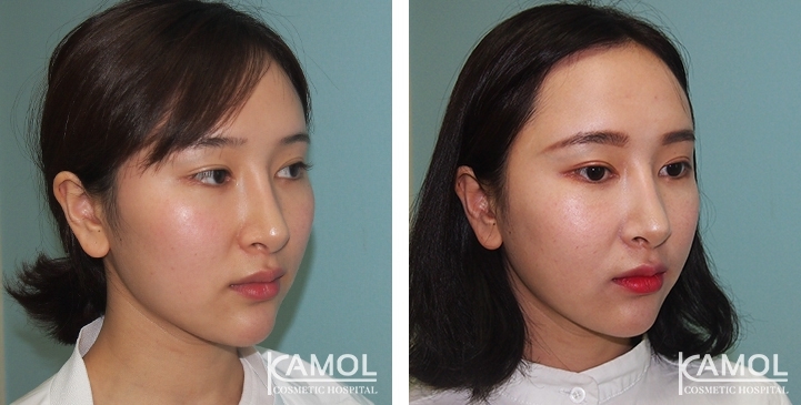 Augmentation des Pommettes / Implant de Joues 14 lg 64949596db533 image