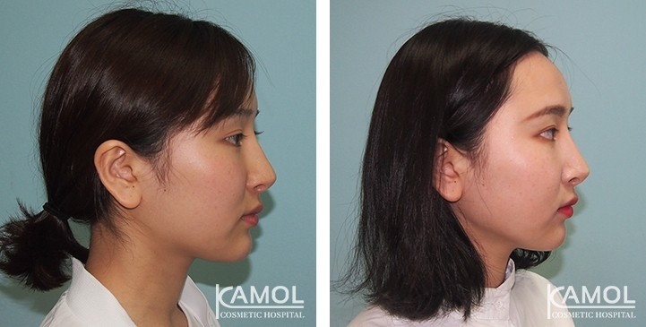 Augmentation des Pommettes / Implant de Joues 13 lg 64949596dd2ad image