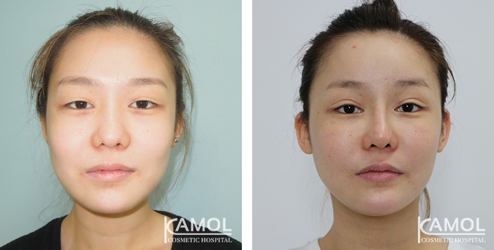 Augmentation des Pommettes / Implant de Joues 24 lg 64949596dfc40 image