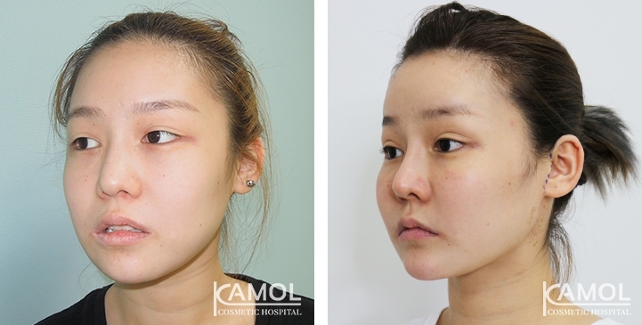 Augmentation des Pommettes / Implant de Joues 28 lg 64949596e1a5f image