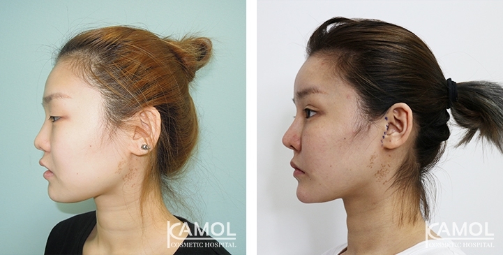 Augmentation des Pommettes / Implant de Joues 27 lg 64949596e39f1 image
