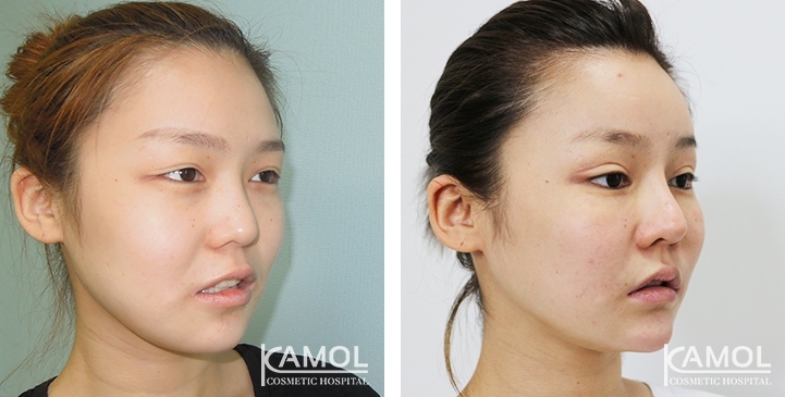 Augmentation des Pommettes / Implant de Joues 26 lg 64949596e58ac image