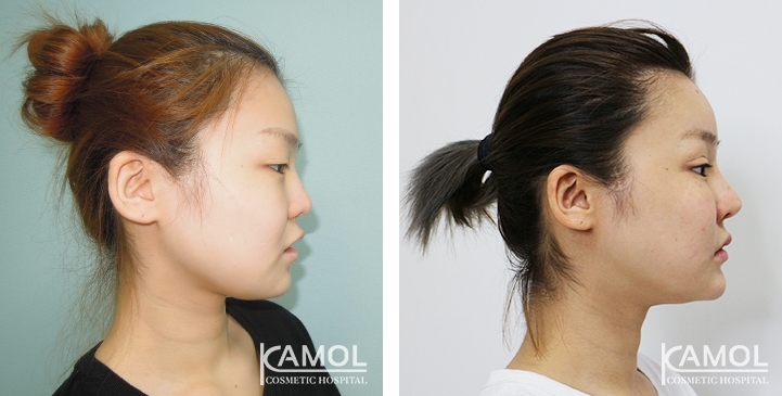 Augmentation des Pommettes / Implant de Joues 25 lg 64949596e7672 image