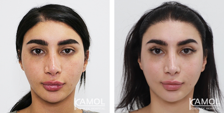 Augmentation des Pommettes / Implant de Joues 30 lg 64949596ea16c image