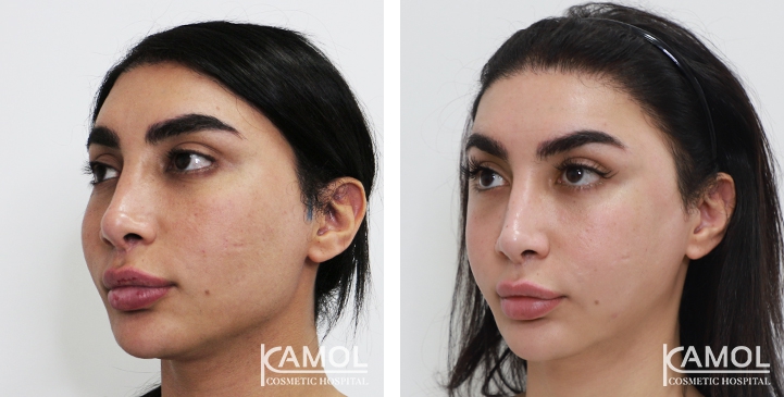 Augmentation des Pommettes / Implant de Joues 34 lg 64949596ec2dc image
