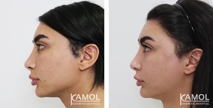 Augmentation des Pommettes / Implant de Joues 33 lg 64949596ee3f2 image