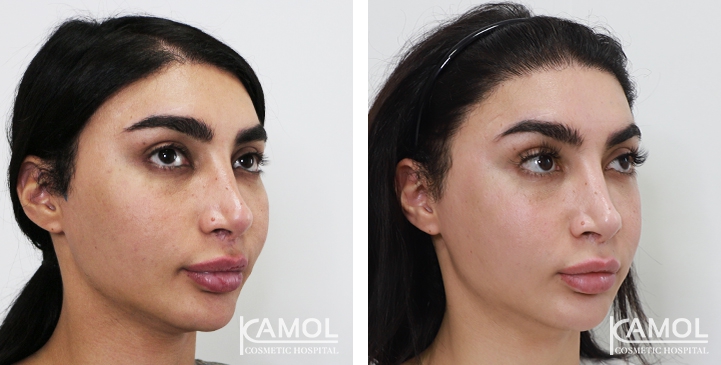 Augmentation des Pommettes / Implant de Joues 31 lg 64949596f0670 image