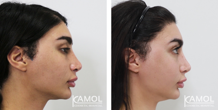 Augmentation des Pommettes / Implant de Joues 32 lg 64949596f285d image