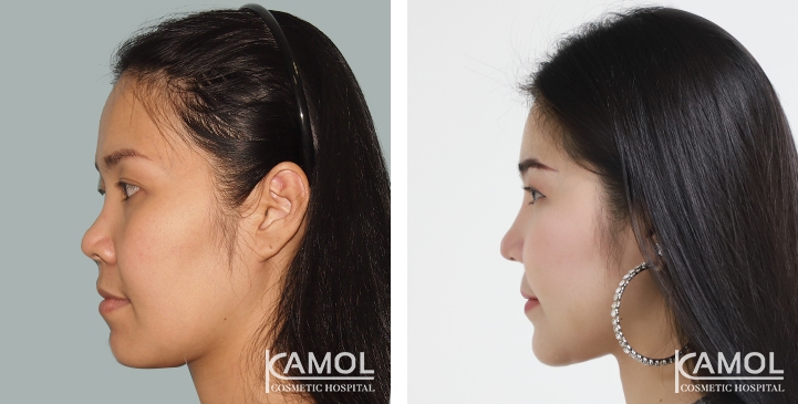 Augmentation des Pommettes / Implant de Joues 40 lg 6494959703cb3 image
