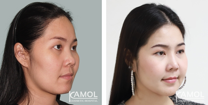 Augmentation des Pommettes / Implant de Joues 37 lg 649495970552f image