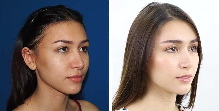 Redução do Queixo / Genioplastia 12 lg 64949598e2f14 image