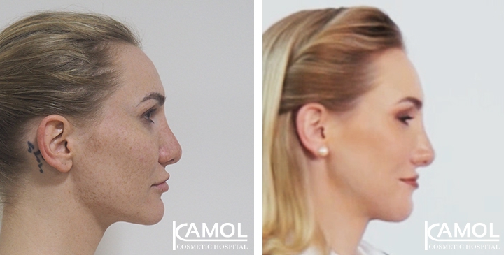 Redução do Queixo / Genioplastia 16 lg 64949598f0a49 image