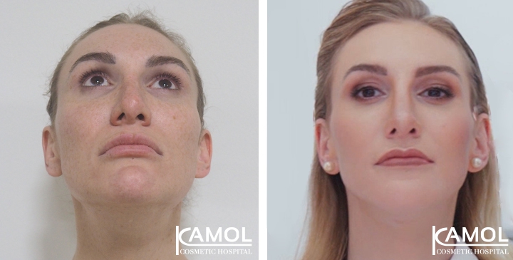 Redução do Queixo / Genioplastia 15 lg 64949598f24e5 image