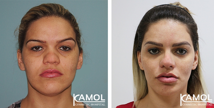 Redução do Queixo / Genioplastia 27 lg 64949599086b6 image