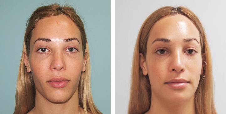 Redução do Queixo / Genioplastia 33 lg 6494959911123 image