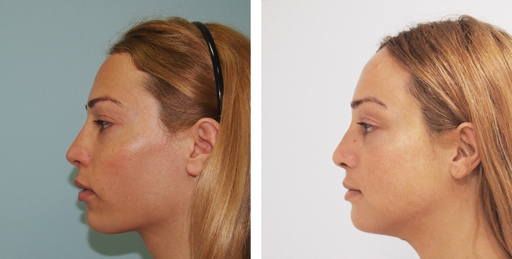 Redução do Queixo / Genioplastia 37 lg 6494959913fc0 image