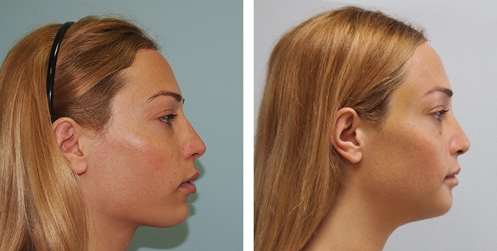 Redução do Queixo / Genioplastia 34 lg 6494959917062 image