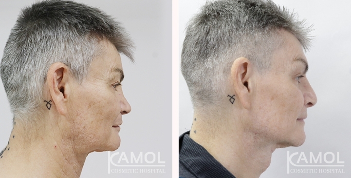 Cirurgia de Masculinização Facial / FMS 2 lg 649495992693b image