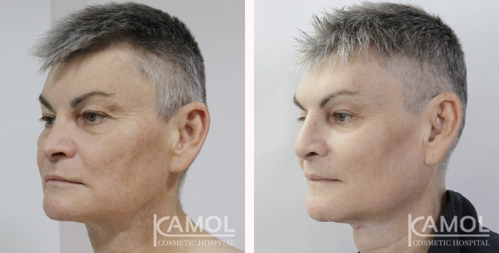 Cirurgia de Masculinização Facial / FMS 5 lg 649495992e80f image